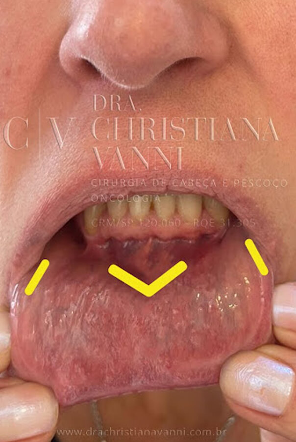 demarcação das incisões para cirurgia por acesso vestibular
