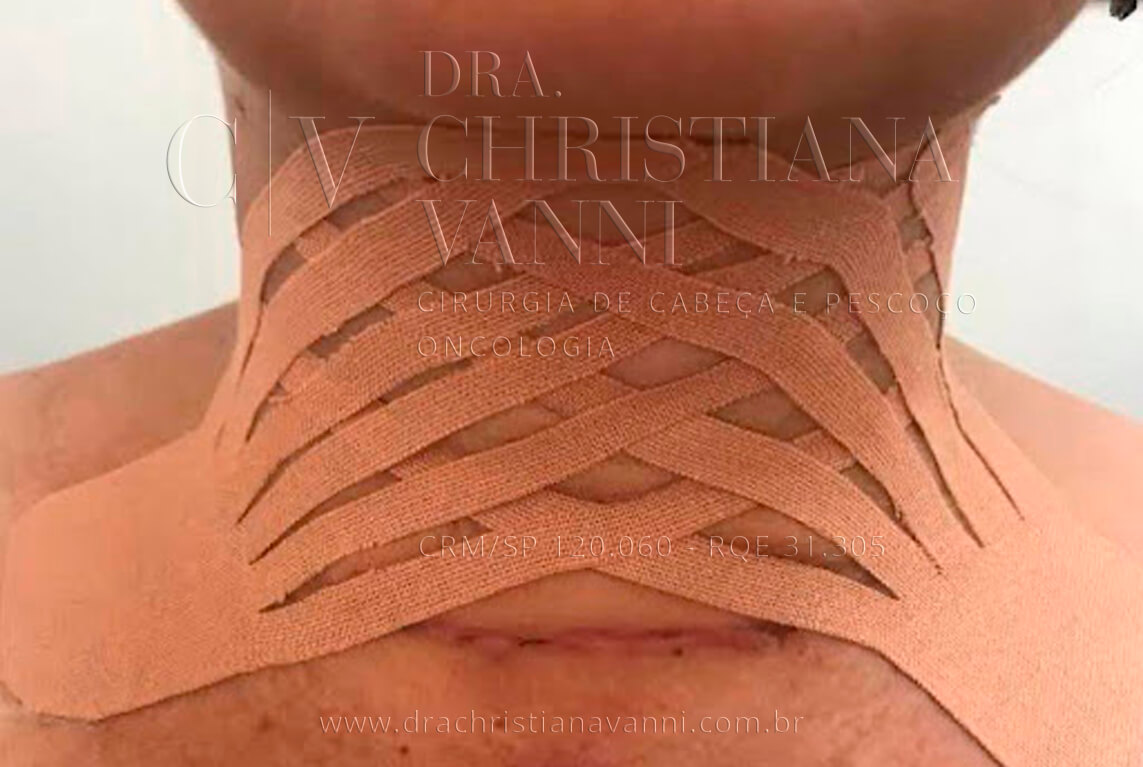 tapping para prevenção de seroma e fibrose no pós operatório
