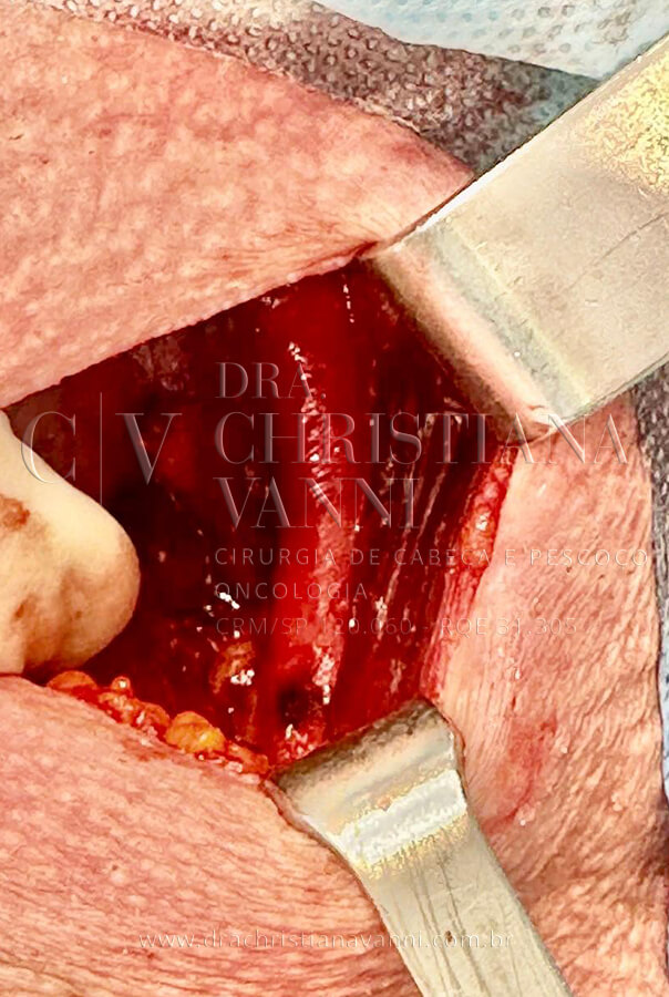 Cirurgia de Bócio Mergulhante (após extirpação)