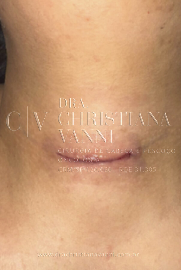 Pós imediato de cirurgia de tireoide