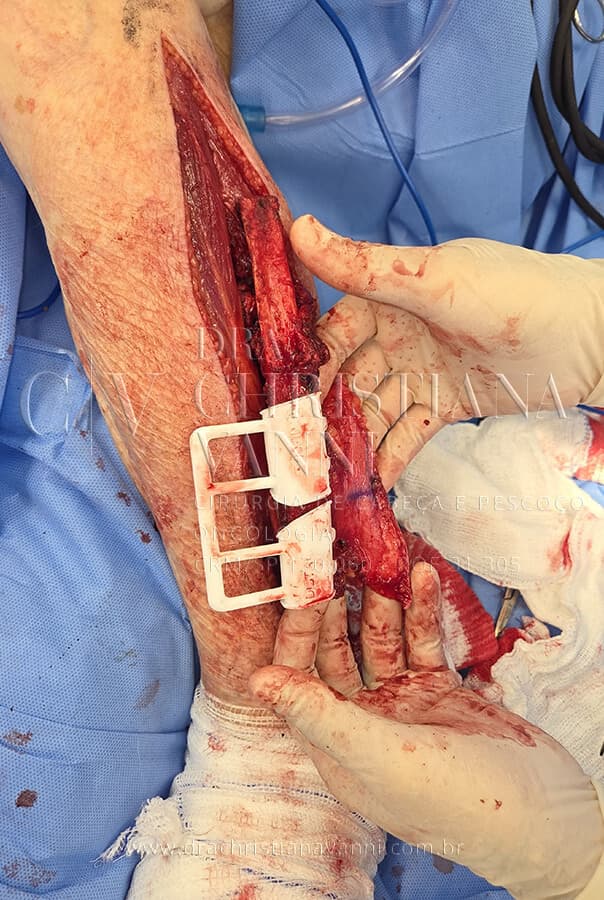 Cirurgia de reconstrução de mandíbula
