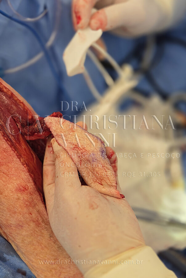 Cirurgia de reconstrução de mandíbula