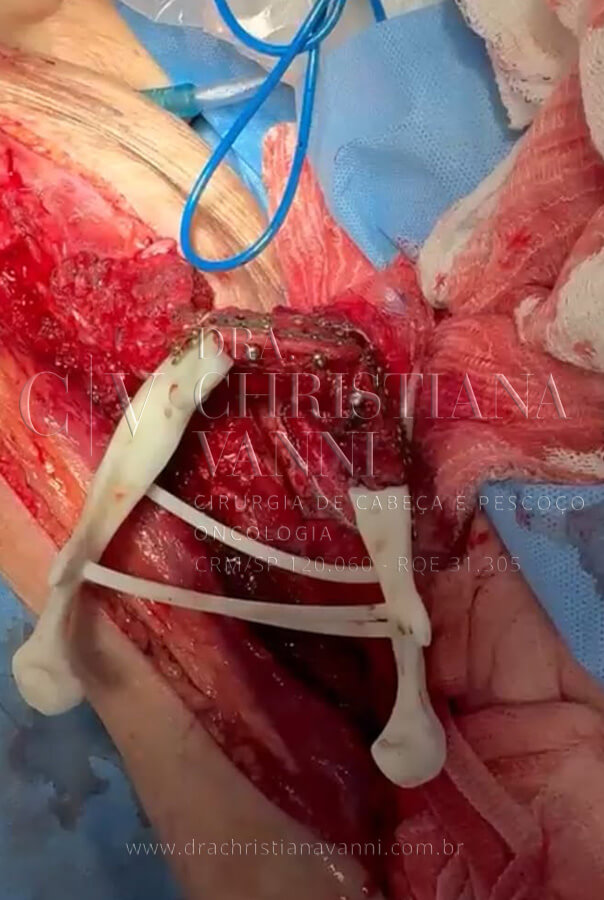 Cirurgia de reconstrução de mandíbula