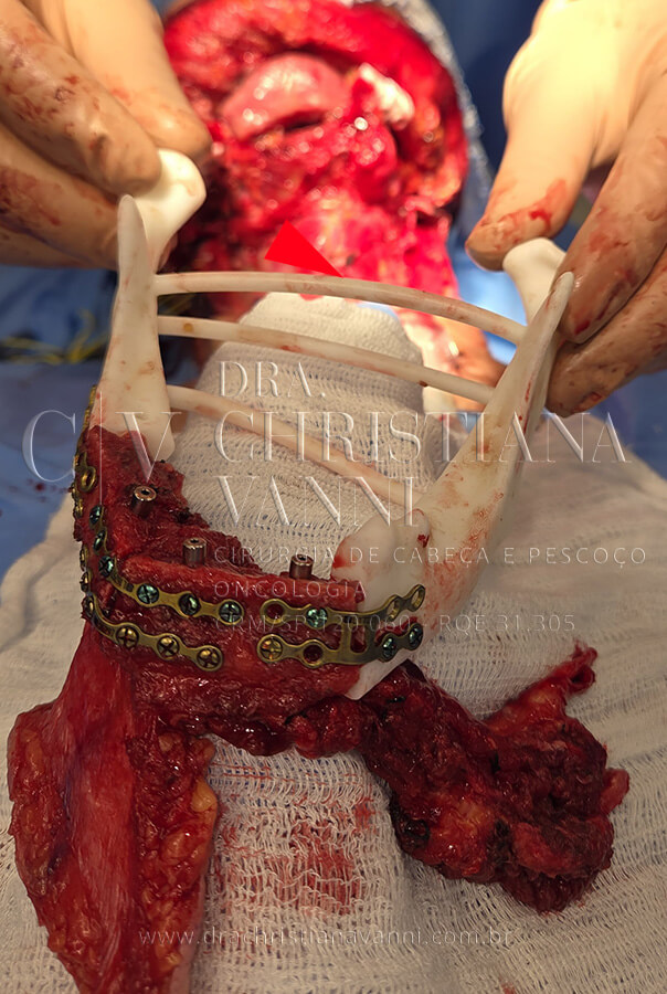 Cirurgia de reconstrução de mandíbula