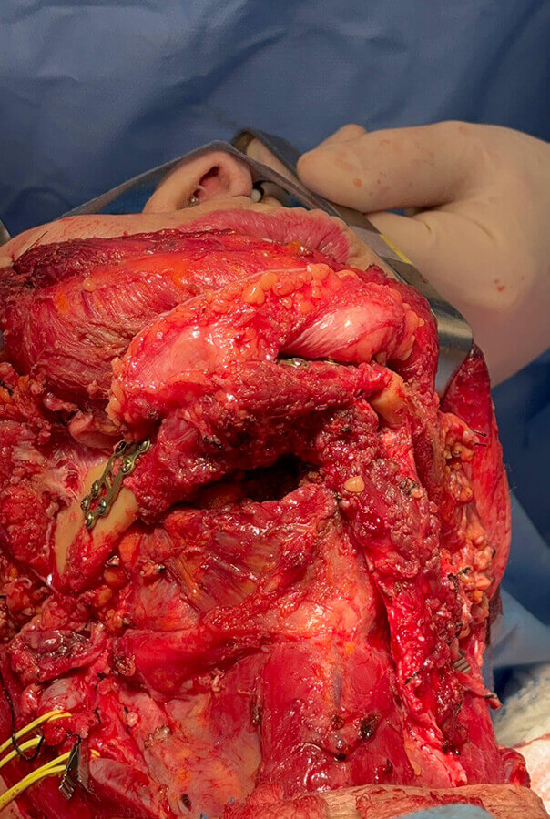 Cirurgia de reconstrução de mandíbula
