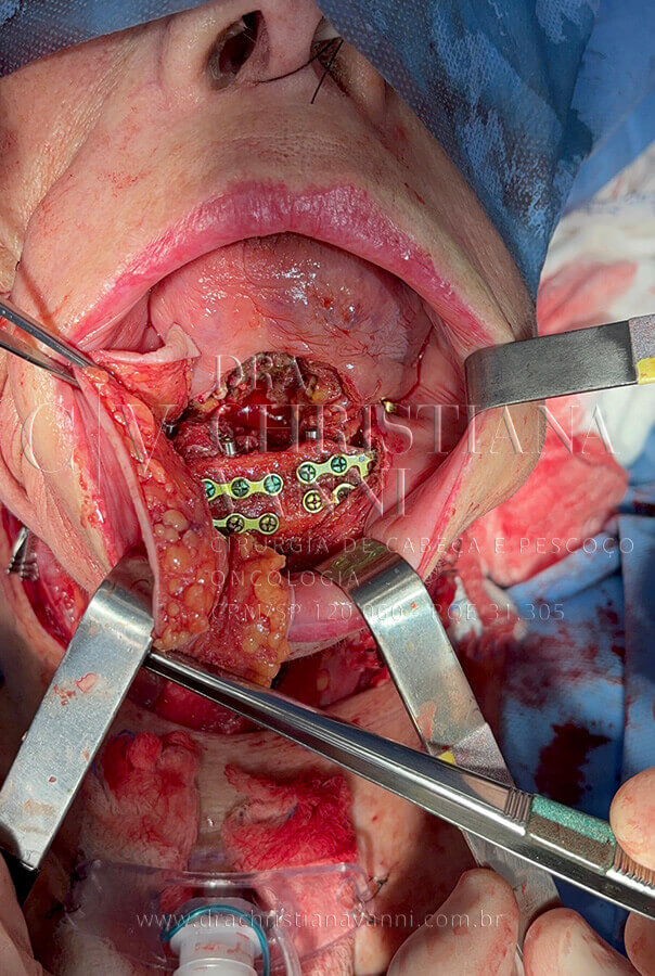 Cirurgia de reconstrução de mandíbula