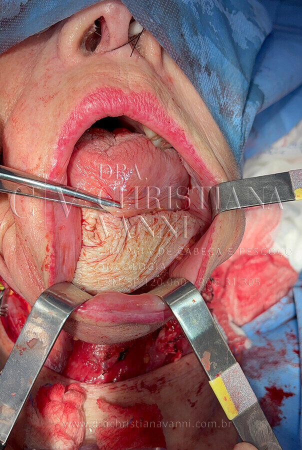 Cirurgia de reconstrução de mandíbula