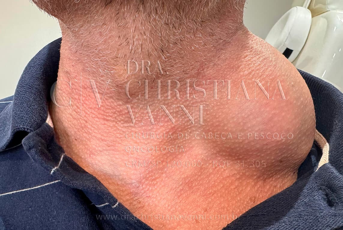 lipoma no pescoço