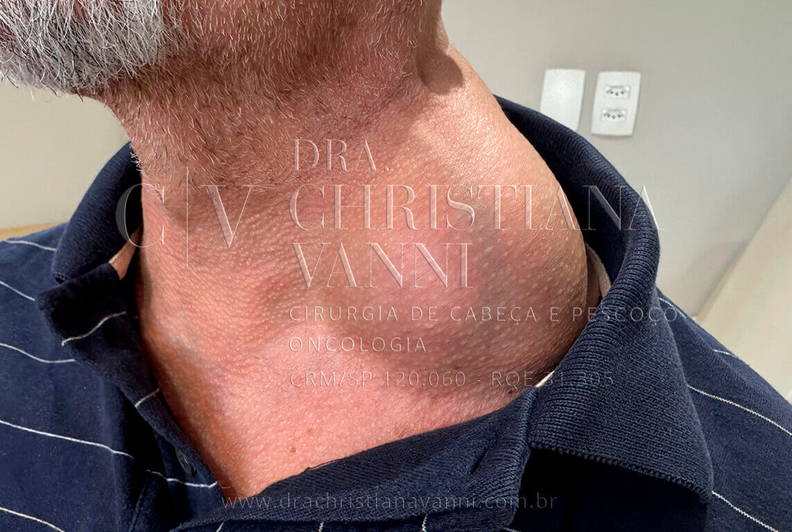 lipoma no pescoço