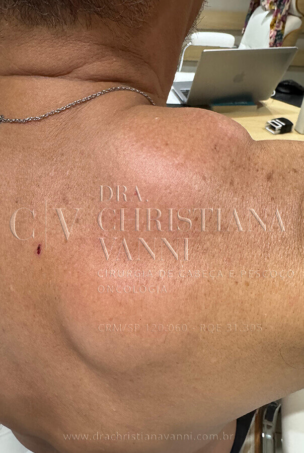 lipoma no pescoço