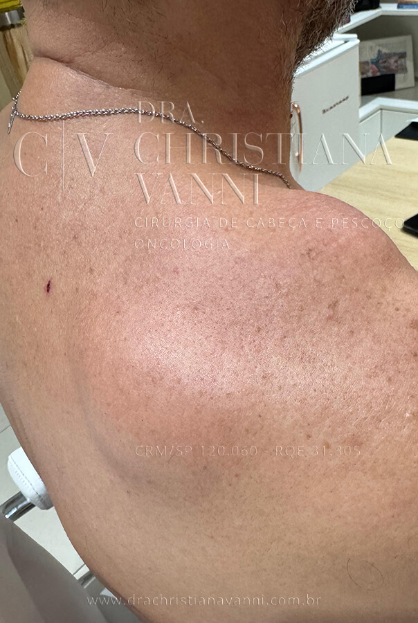 lipoma no pescoço