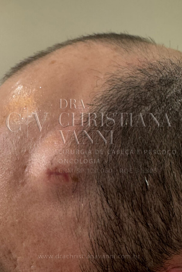 Lipoma na cabeça