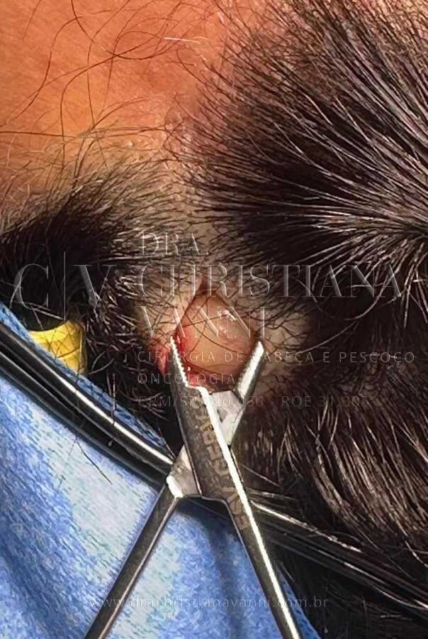 Cirurgia de cisto no couro cabeludo