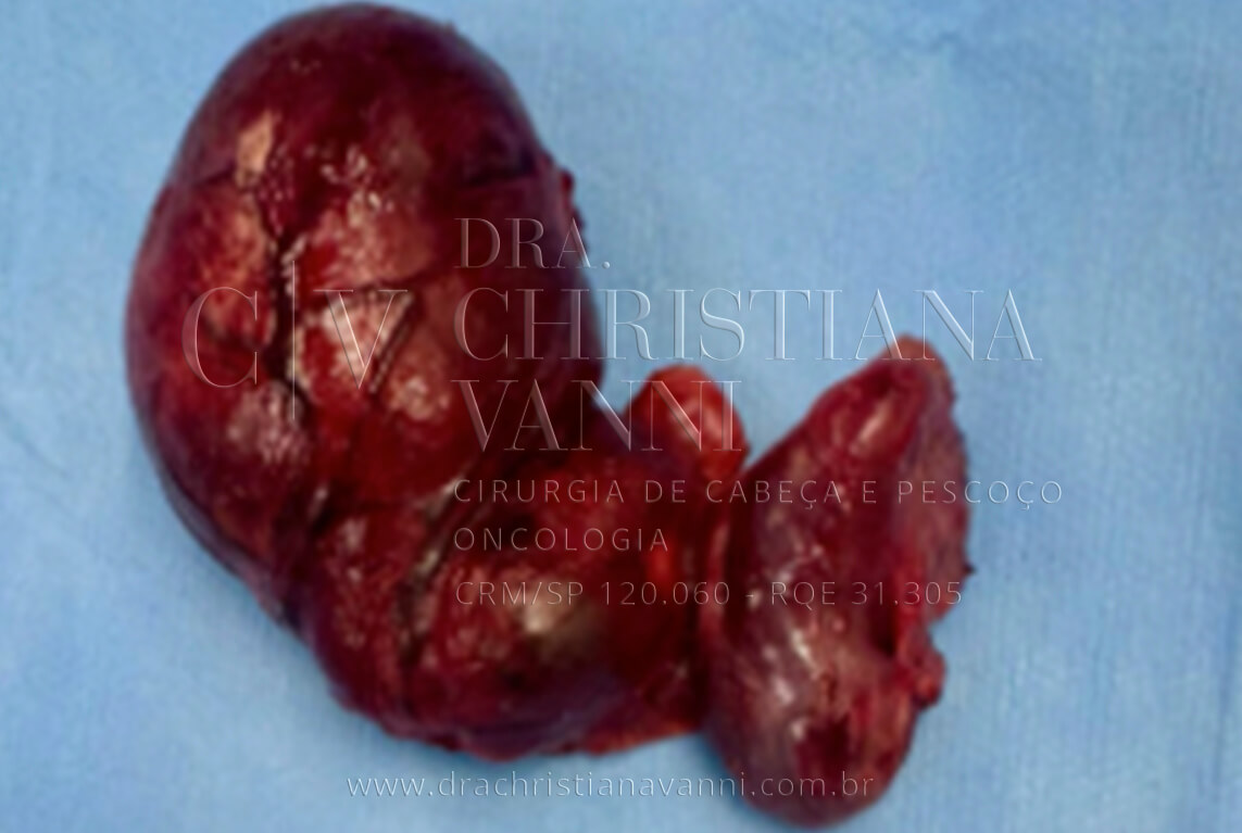 Cintilografia da tireoide