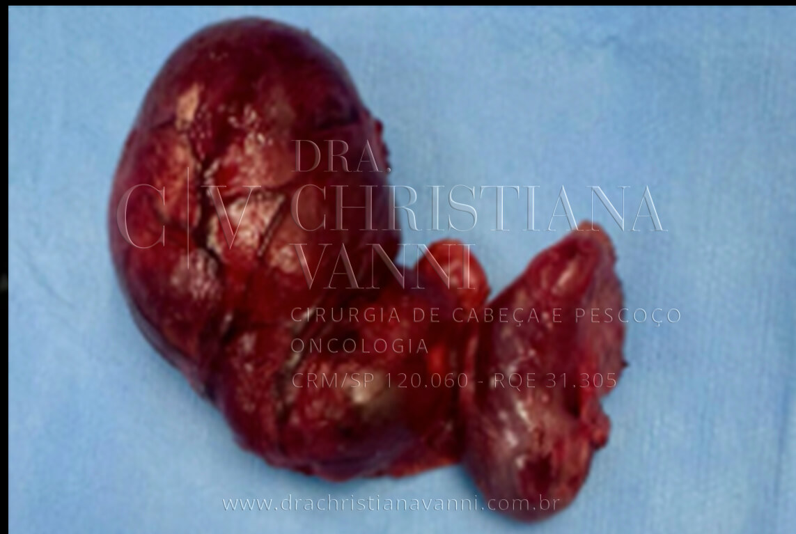 Cirurgia de nódulo hiperfuncionante (lobectomia direita com porção do istmo e parte do lobo esquerdo)
