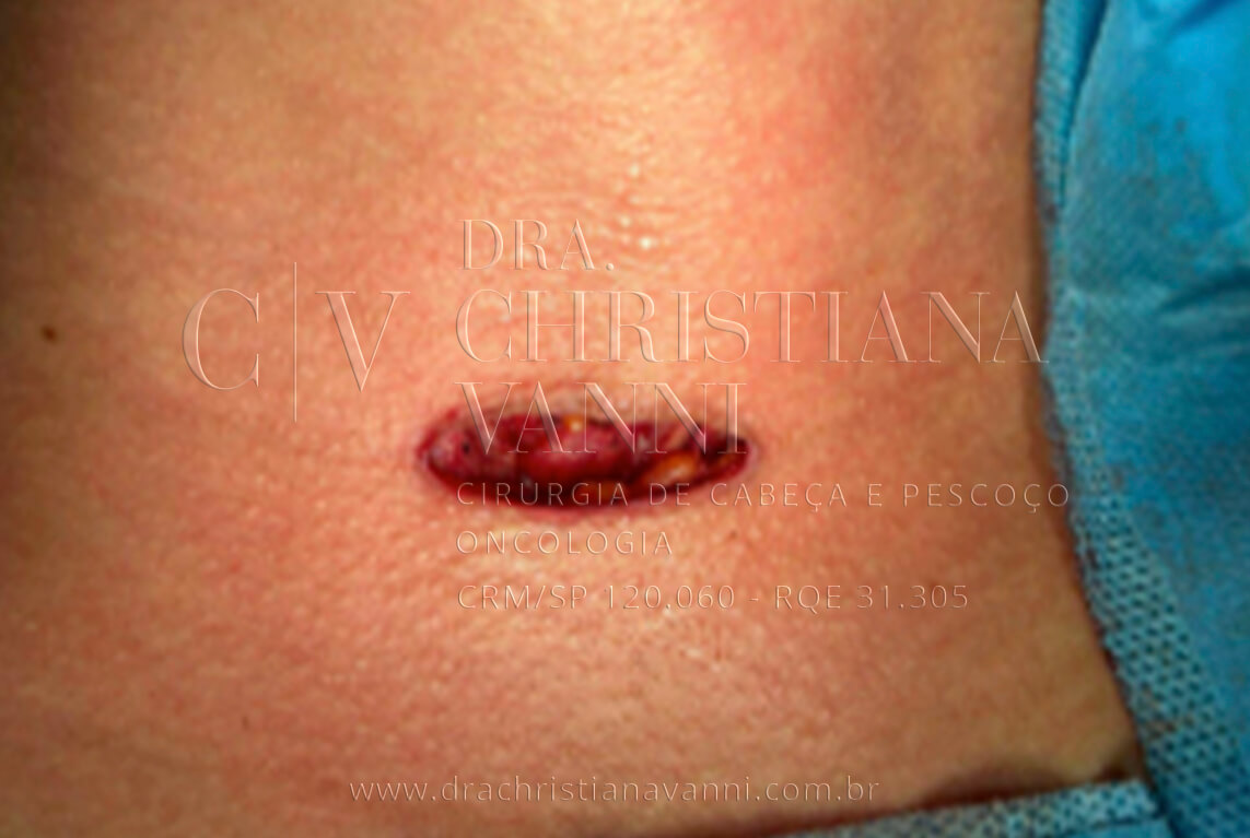 Cirurgia de nódulo hiperfuncionante (lobectomia direita com porção do istmo e parte do lobo esquerdo)