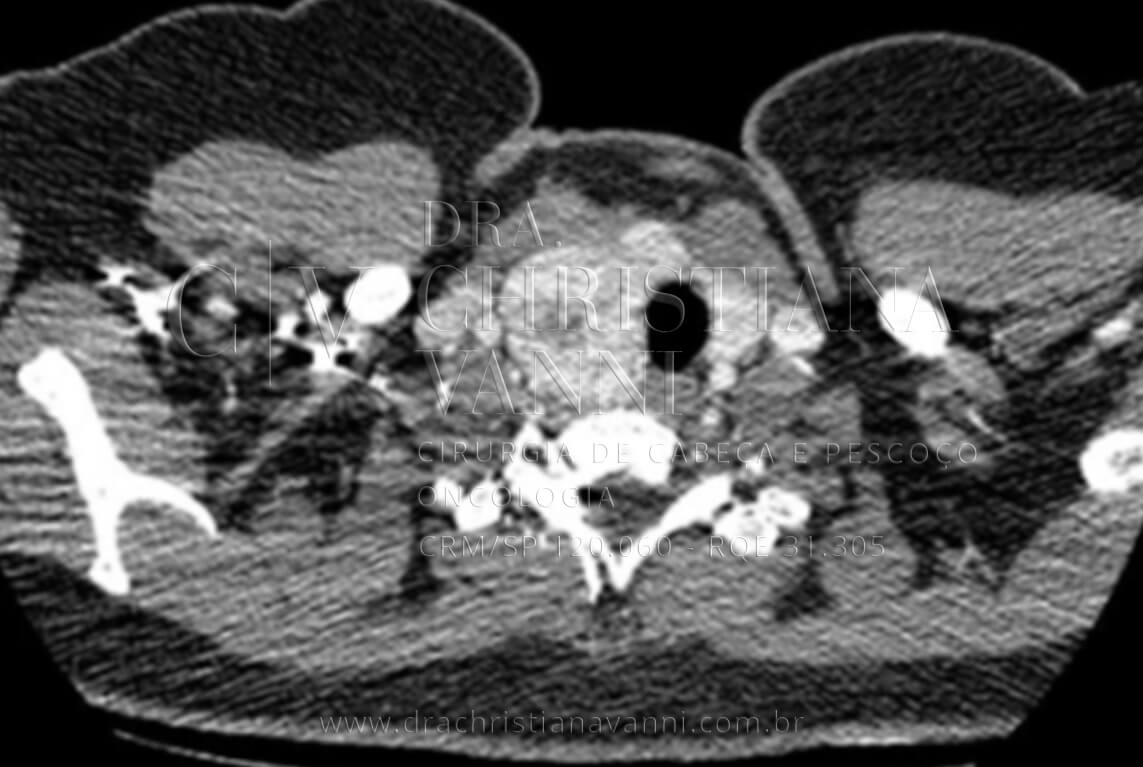 Bócio mergulhante com desvio e compressão de traqueia