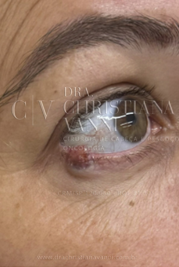 Foto de câncer no olho