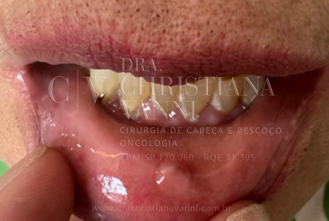 Foto de fibroma