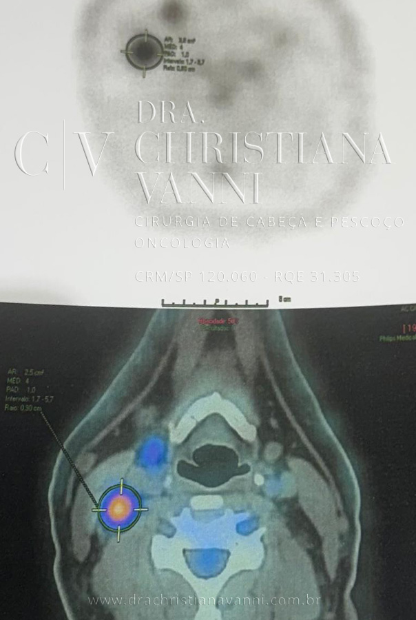 PET-CT de tireoide com metástase linfonodal cervical lateral