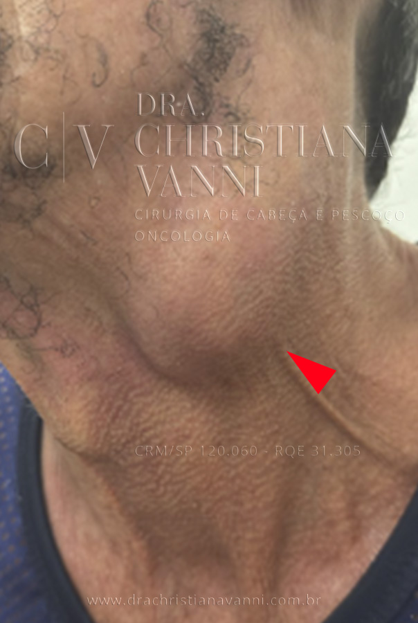 Metástase linfonodo cervical