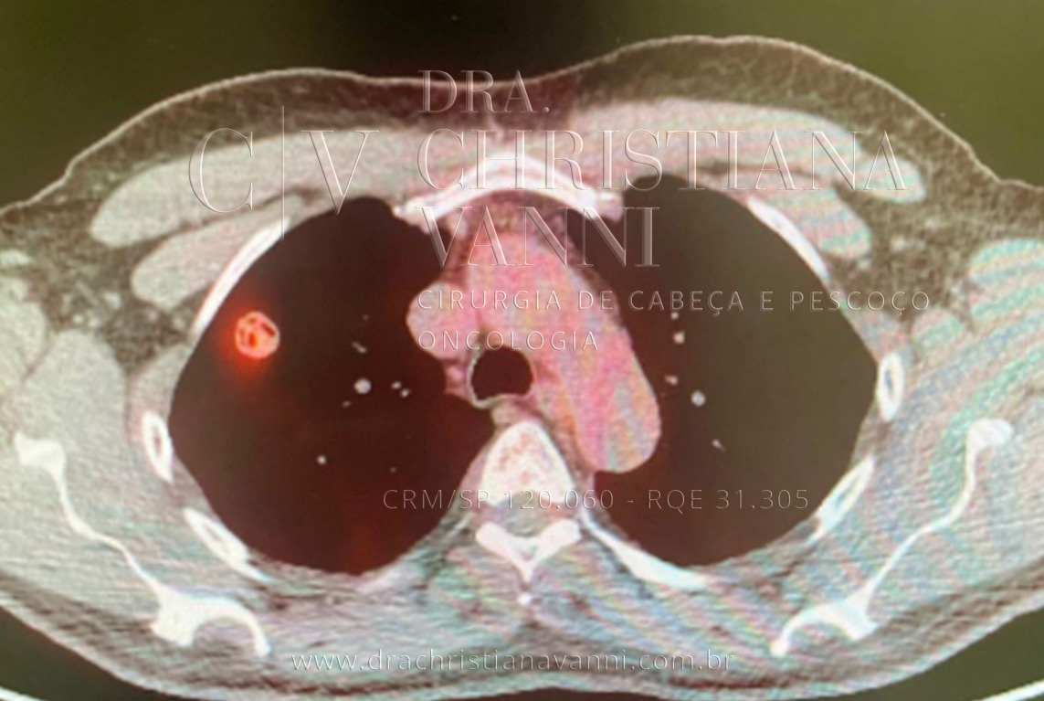 Foto de metástase pulmonar