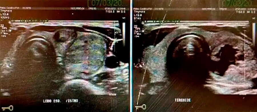 Ablação da Tireoide Antes e Depois