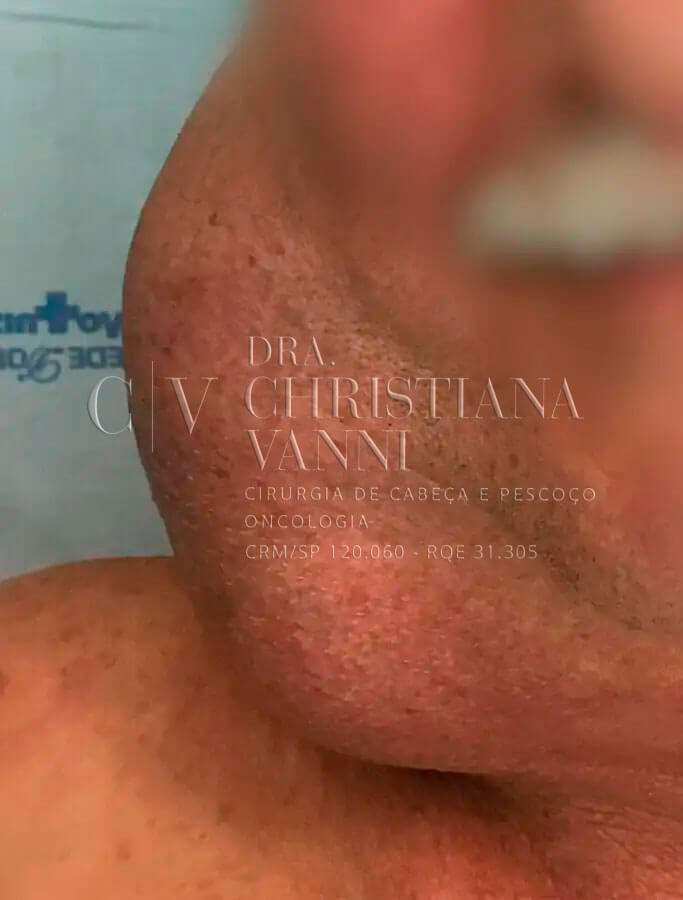 Cirurgia de Câncer de Glândulas Salivares - Melhor Cirurgião
Especialista
