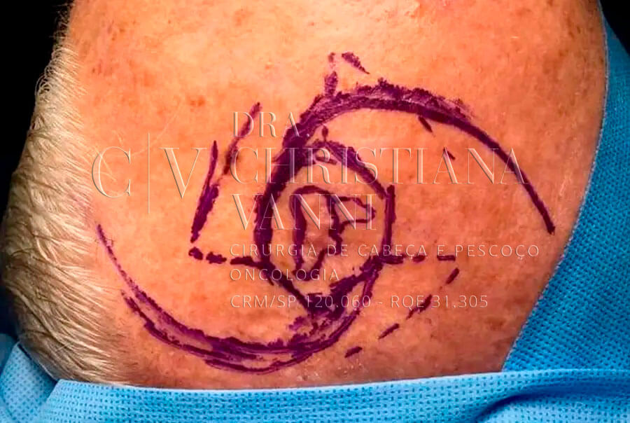 Cirurgia de Câncer de Pele no Nariz em Brasília