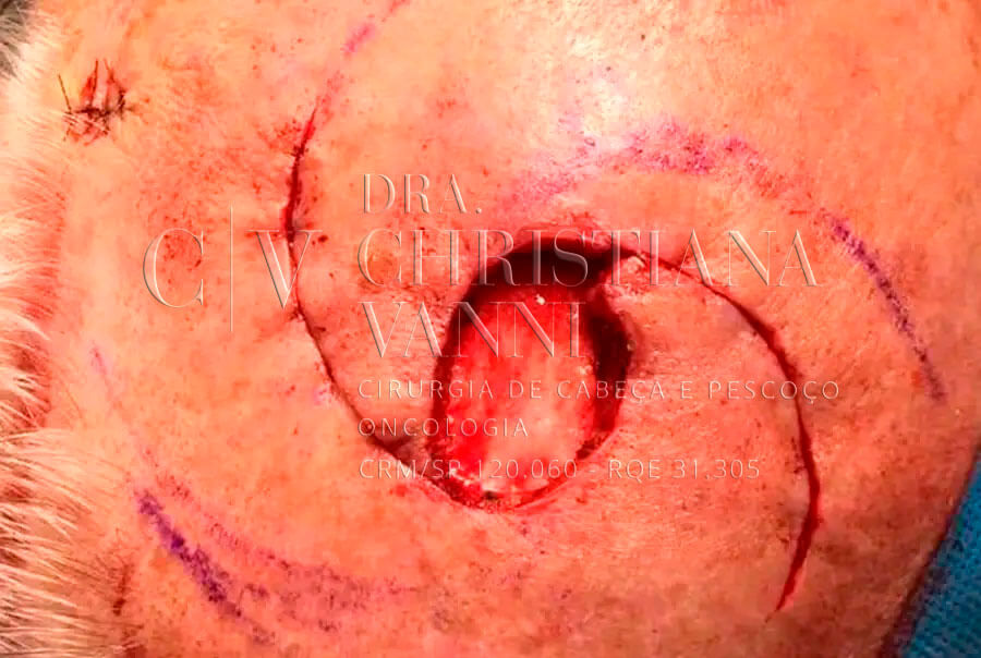 Cirurgia de Câncer de Pele no Nariz em Brasília