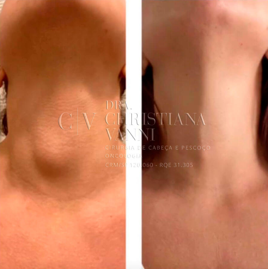 Cirurgia de Tireoide Antes e Depois