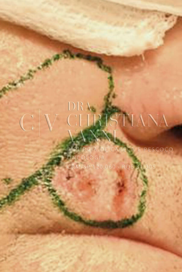 Cirurgia de Câncer de Pele no Rosto