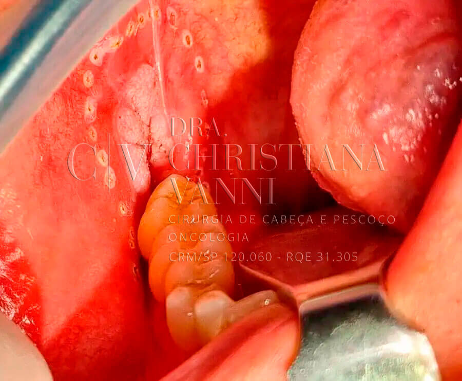 Cirurgia de Leucoplasia - Fotos Antes e Depois