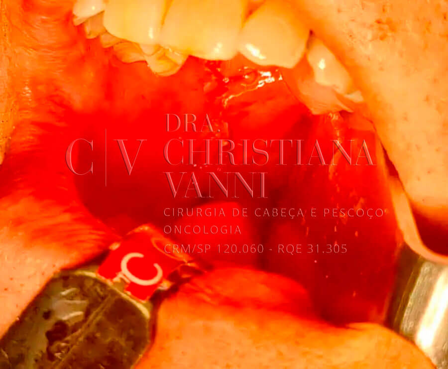 Cirurgia de Leucoplasia - Fotos Antes e Depois