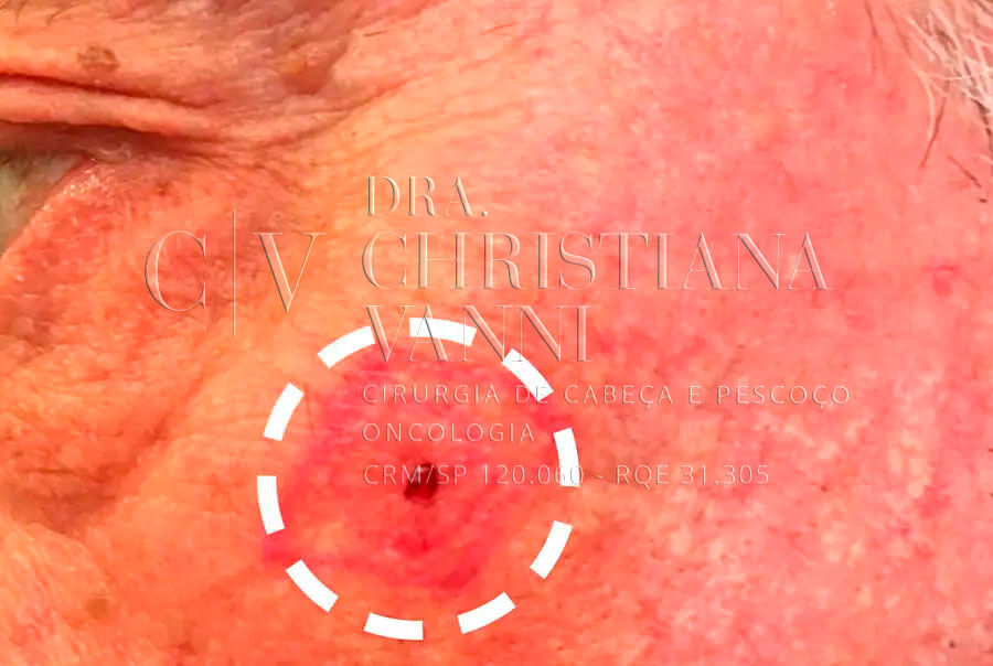 Foto de Tumor malígno - Câncer de Pele