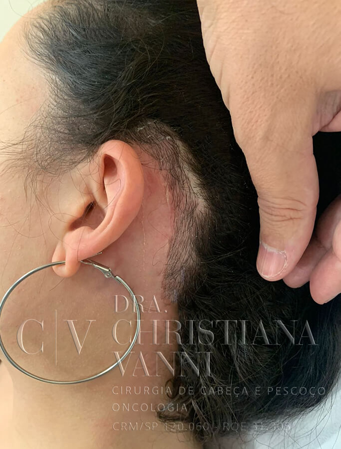 Foto de Cicatriz de Cirurgia de Tireoide