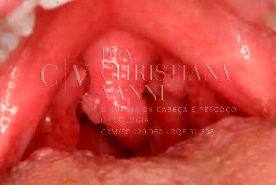 Tumor na garganta - Foto de Câncer de Faringe
