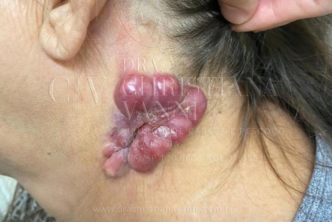 Carcinoma Basocelular
