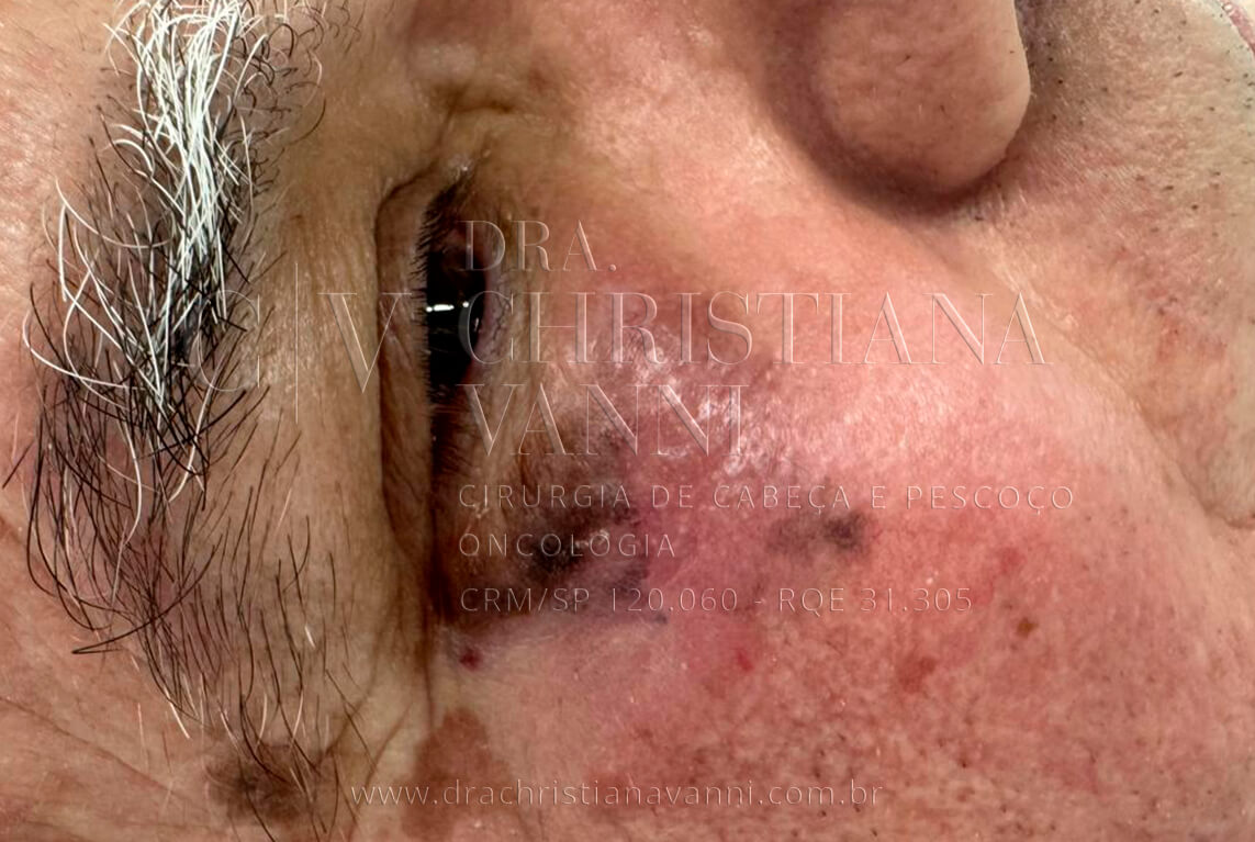 Melanoma