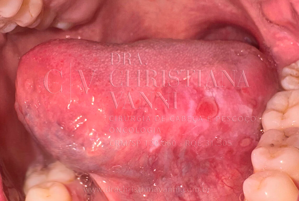 Leucoplasia na Lingua