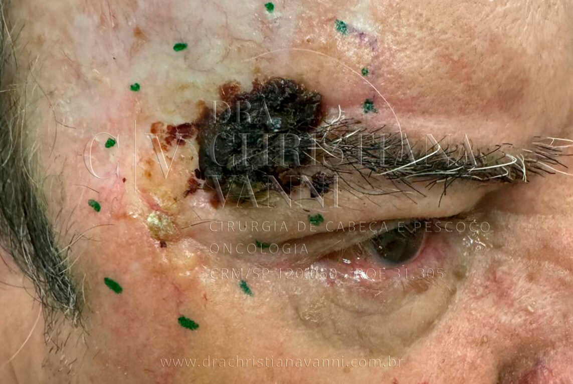 Melanoma