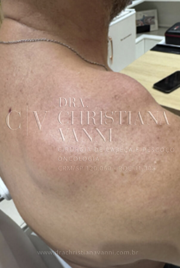 Foto de Lipoma na Cervical