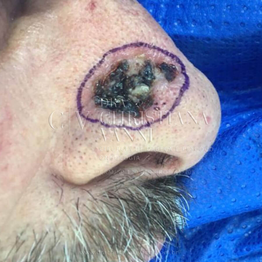 Cirurgia de Câncer de Pele Melanoma no Nariz