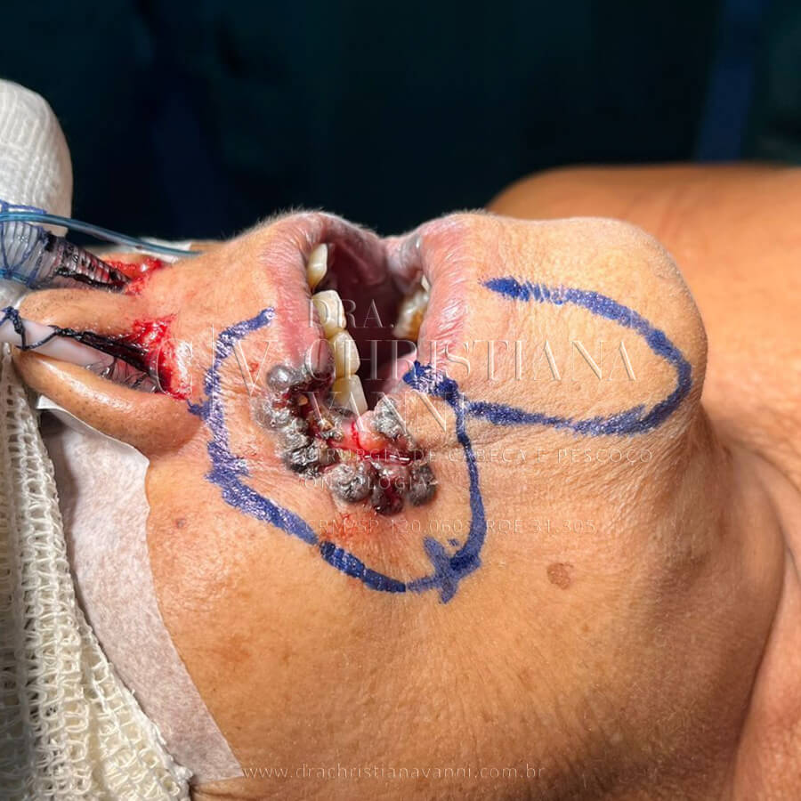 Cirurgia de Câncer de Pele Melanoma na Boca