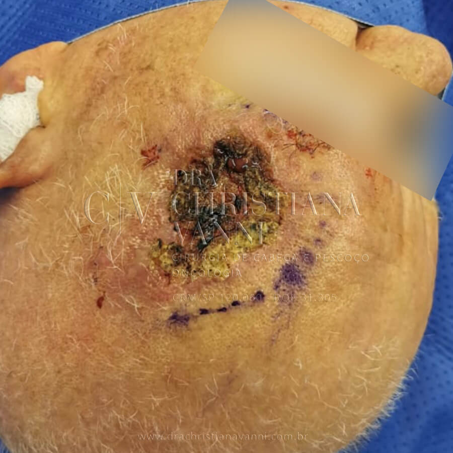 Cirurgia de Câncer de Pele Melanoma na Testa