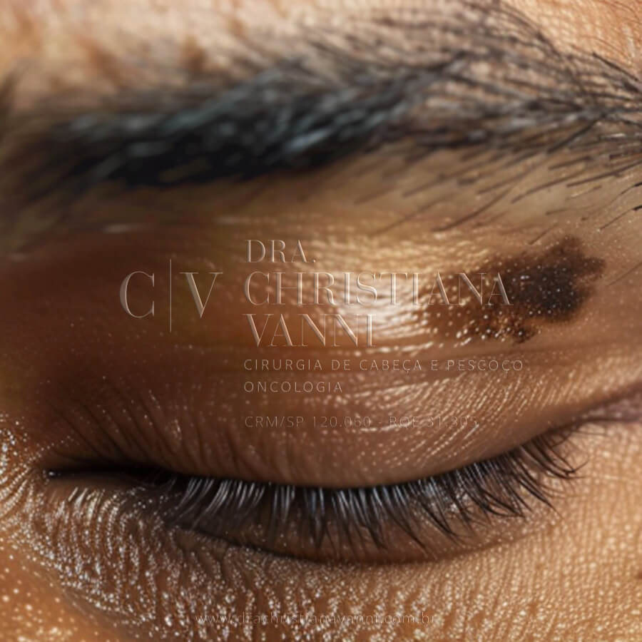 Melanoma Fotos