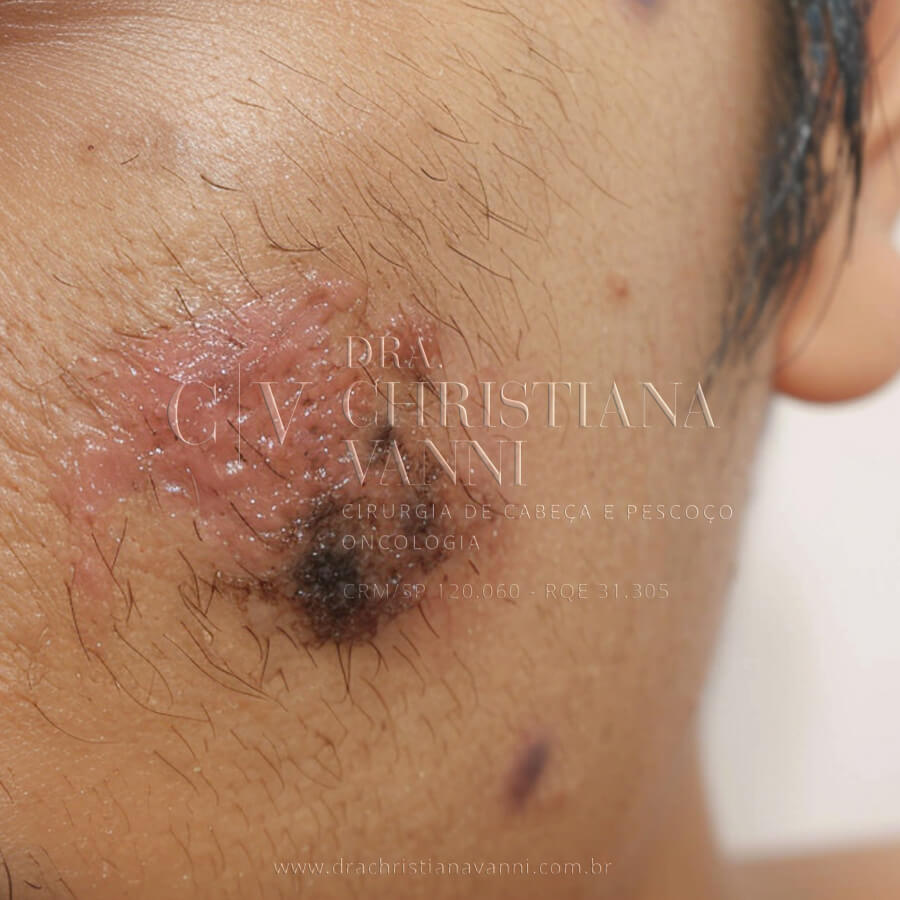 Tumor de Pele Maligno Melanoma