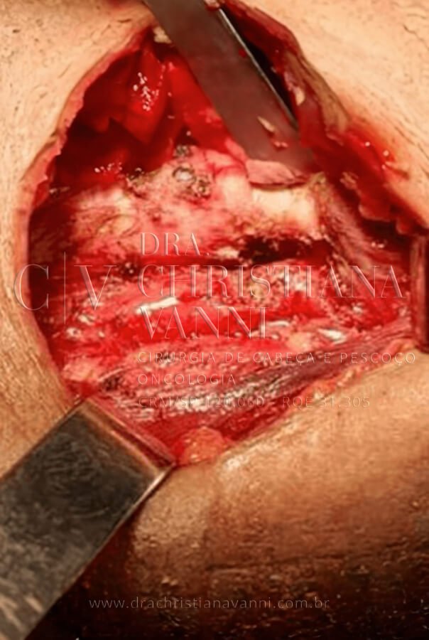 Foto de Tumor Ósseo de Tireoide Benigno