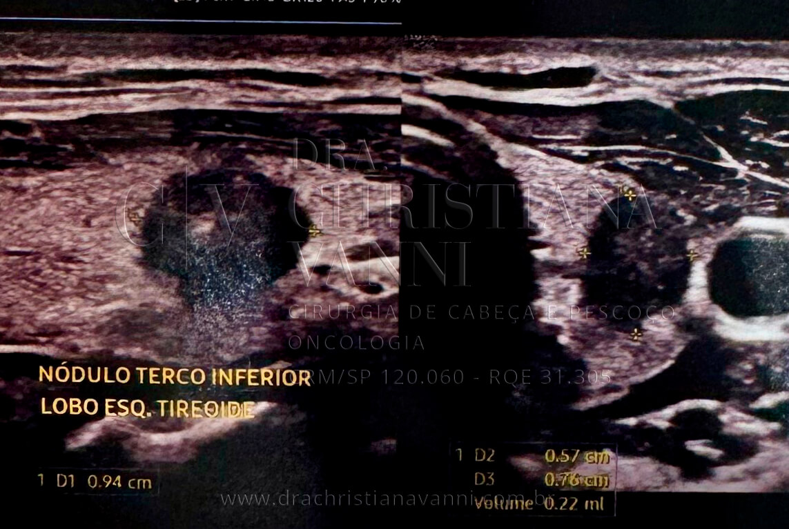 Ultrassonografia de tireoide