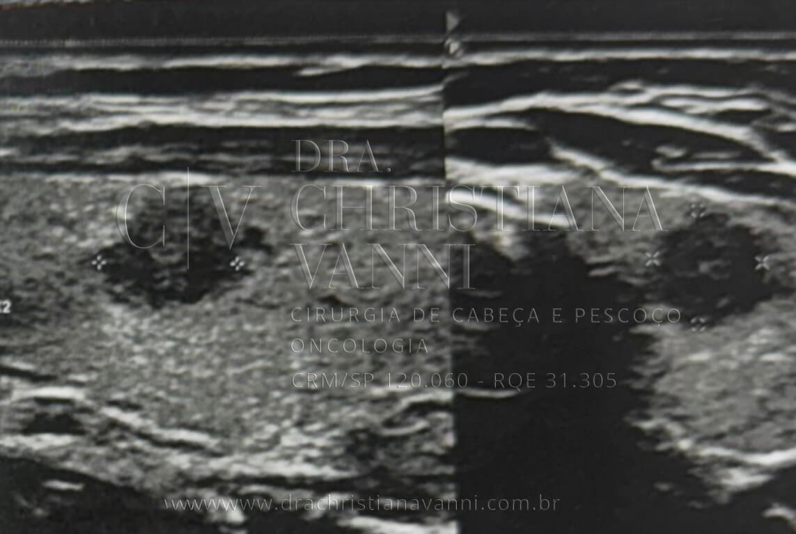 Ultrassonografia Carcinoma Papilífero